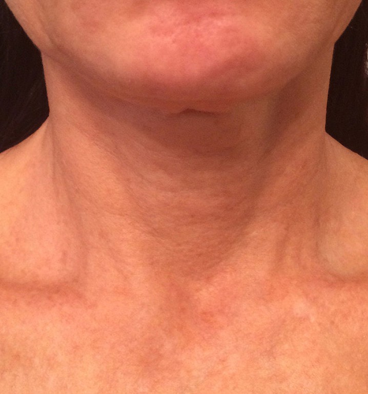 Phyto-Peptide Neck Cream — Week 3