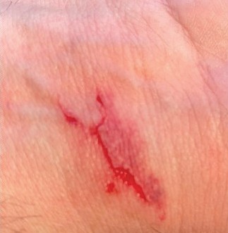 Wound Healing Gel — Before