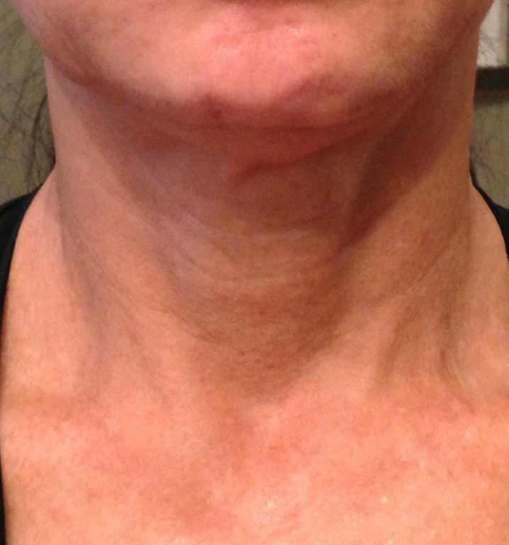 Phyto-Peptide Neck Cream — Baseline